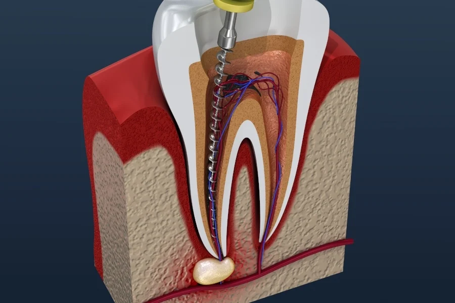 Laser-Assisted Root Canal Therapys